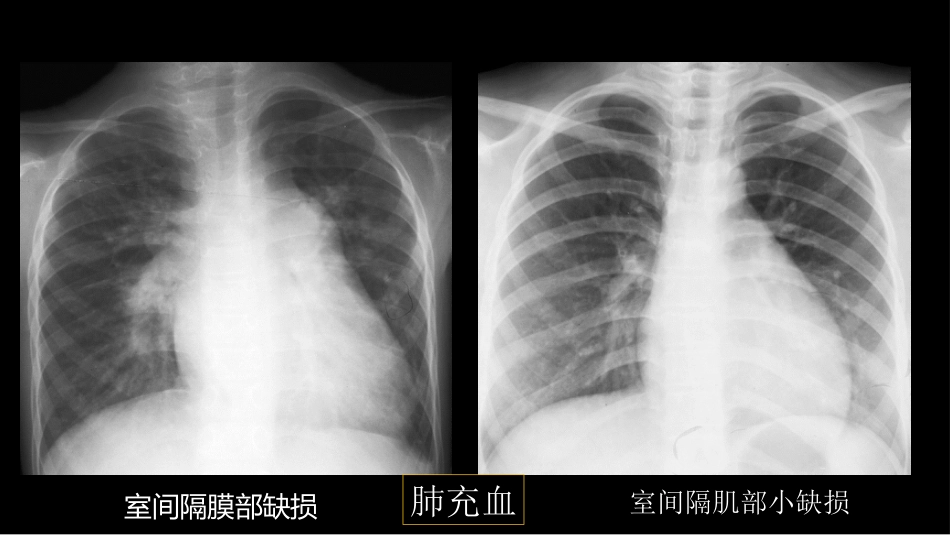 肺血管及肺网状结构影像学与心肺疾病-修改版_第11页