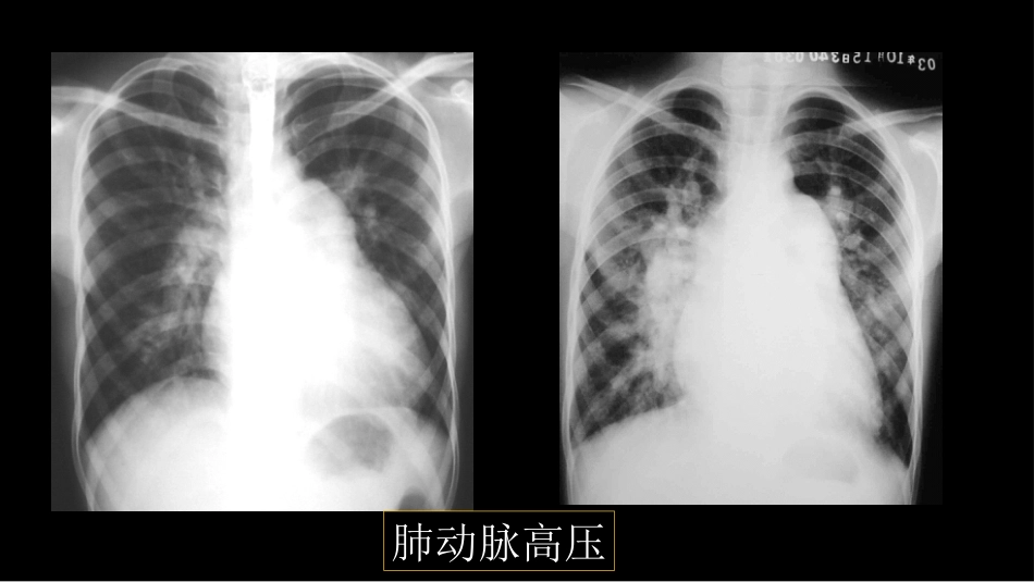 肺血管及肺网状结构影像学与心肺疾病-修改版_第12页