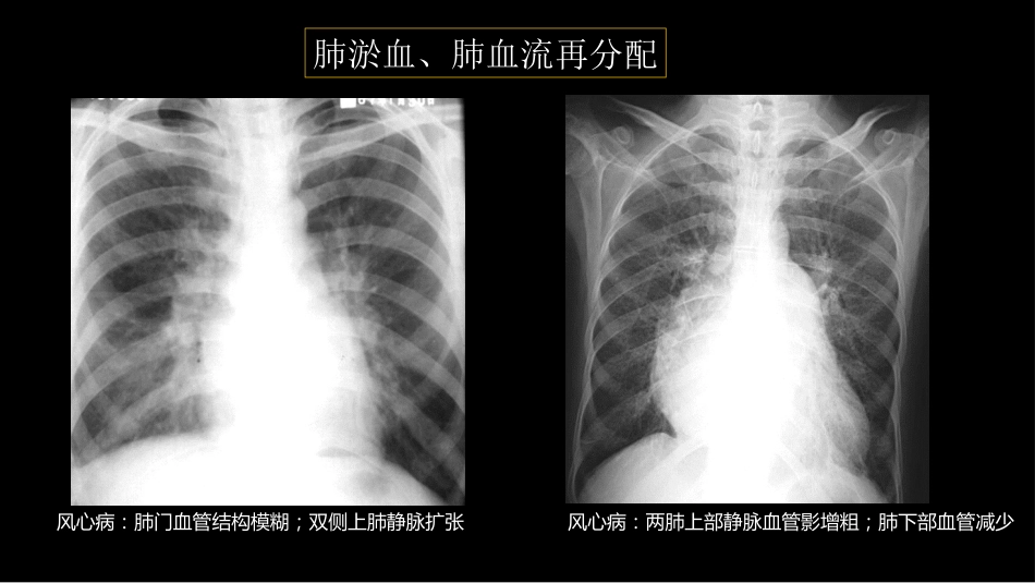 肺血管及肺网状结构影像学与心肺疾病-修改版_第13页