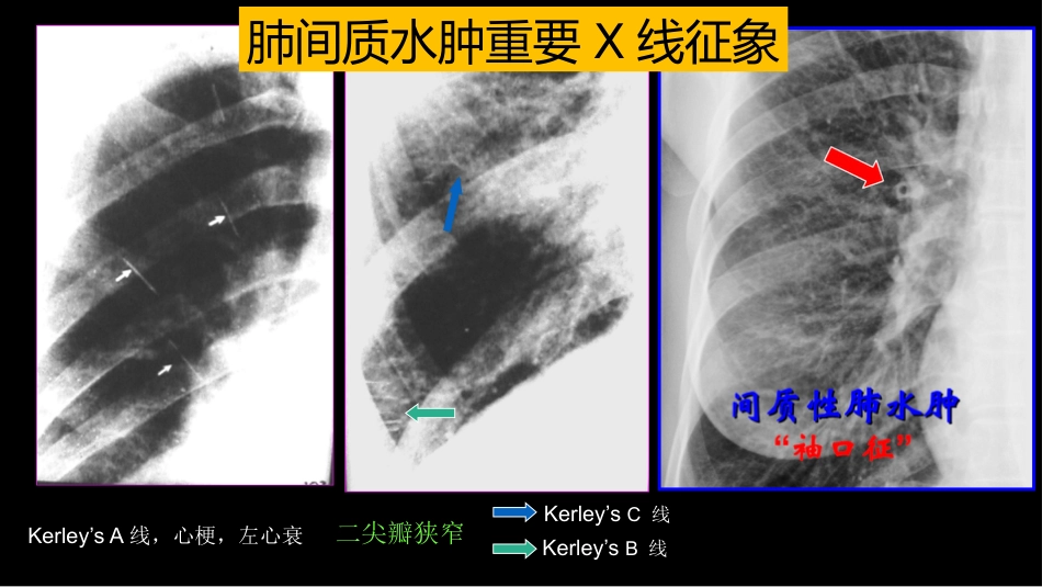 肺血管及肺网状结构影像学与心肺疾病-修改版_第14页