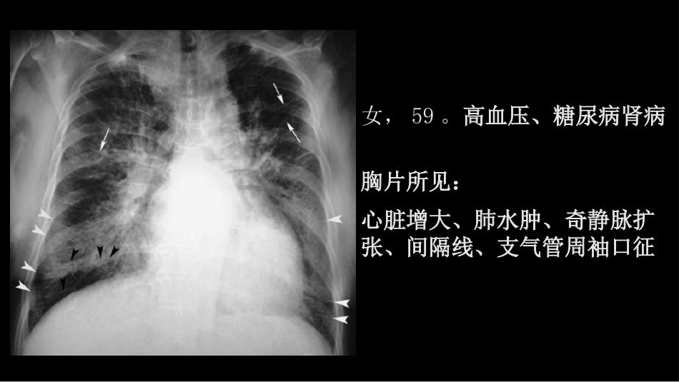 肺血管及肺网状结构影像学与心肺疾病-修改版_第15页