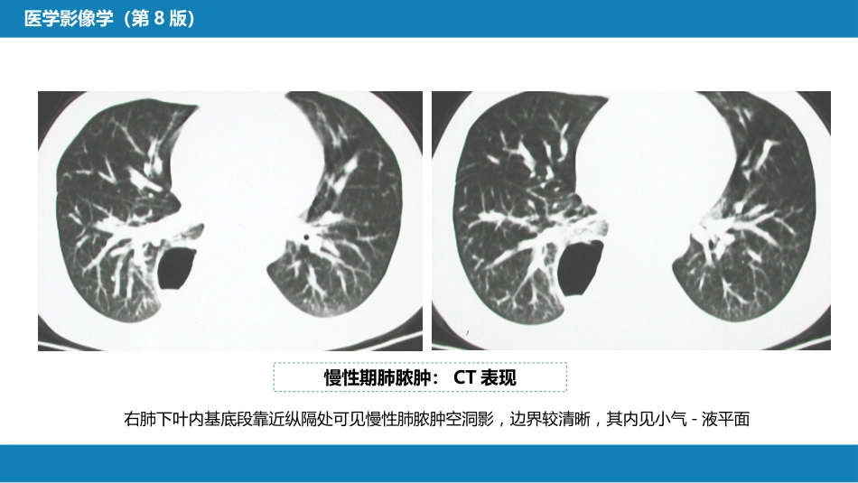 第四章 呼吸系统 第四节 疾病诊断-肺脓肿、肺结核_第10页