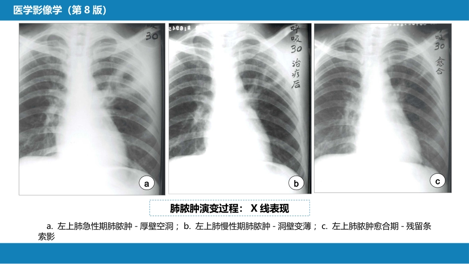 第四章 呼吸系统 第四节 疾病诊断-肺脓肿、肺结核_第11页