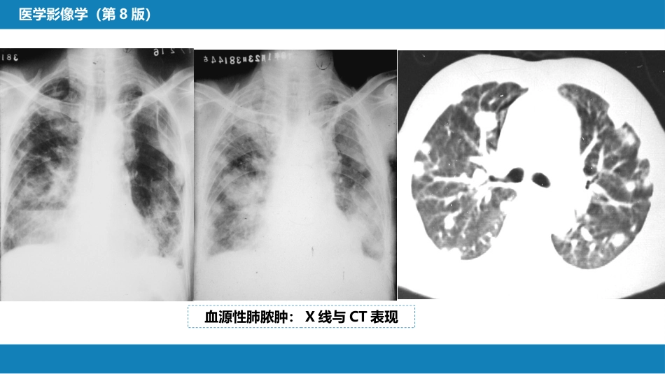 第四章 呼吸系统 第四节 疾病诊断-肺脓肿、肺结核_第13页