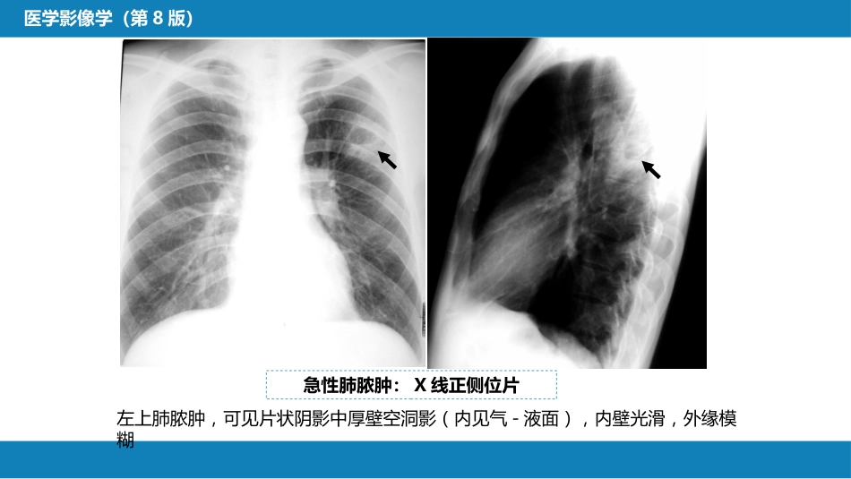 第四章 呼吸系统 第四节 疾病诊断-肺脓肿、肺结核_第7页