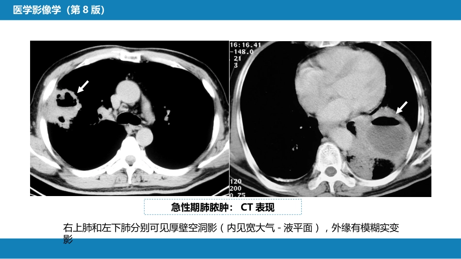第四章 呼吸系统 第四节 疾病诊断-肺脓肿、肺结核_第8页