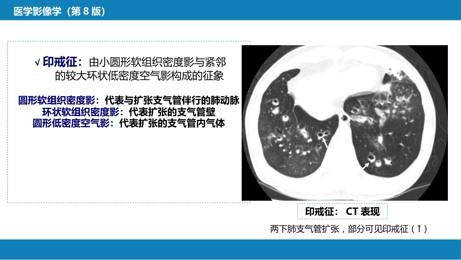 第四章 呼吸系统 第四节 疾病诊断-支气管扩张症、肺炎_第12页