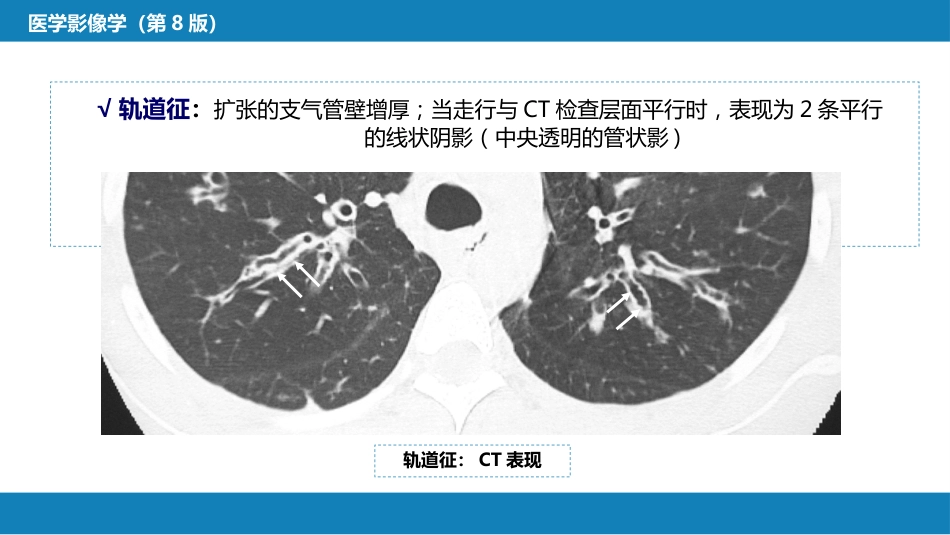 第四章 呼吸系统 第四节 疾病诊断-支气管扩张症、肺炎_第13页