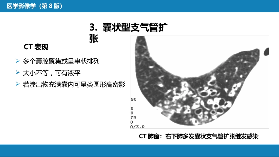 第四章 呼吸系统 第四节 疾病诊断-支气管扩张症、肺炎_第15页