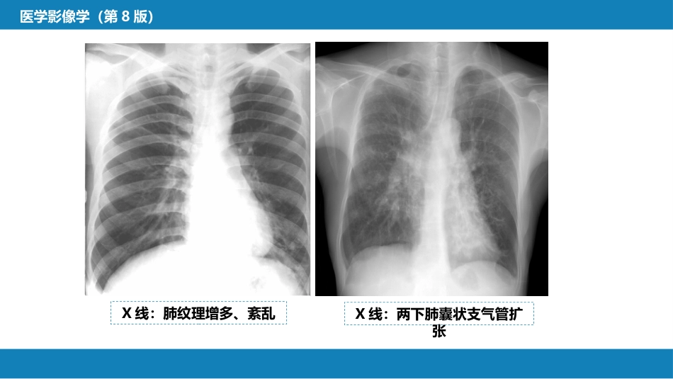 第四章 呼吸系统 第四节 疾病诊断-支气管扩张症、肺炎_第9页