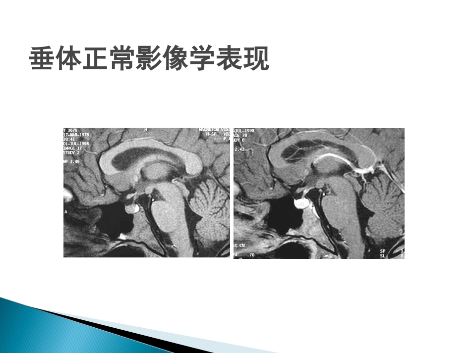 垂体疾病的影像诊断_第10页