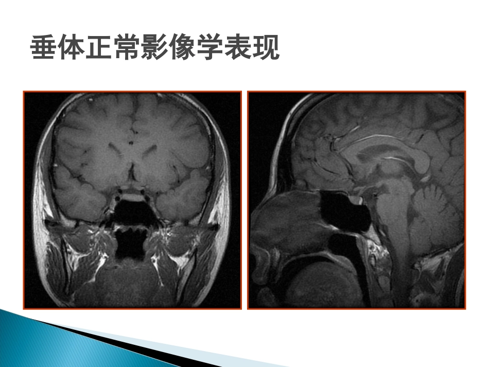 垂体疾病的影像诊断_第11页