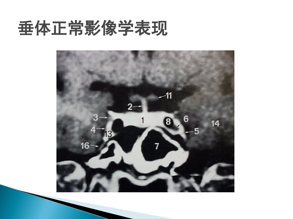 垂体疾病的影像诊断_第12页