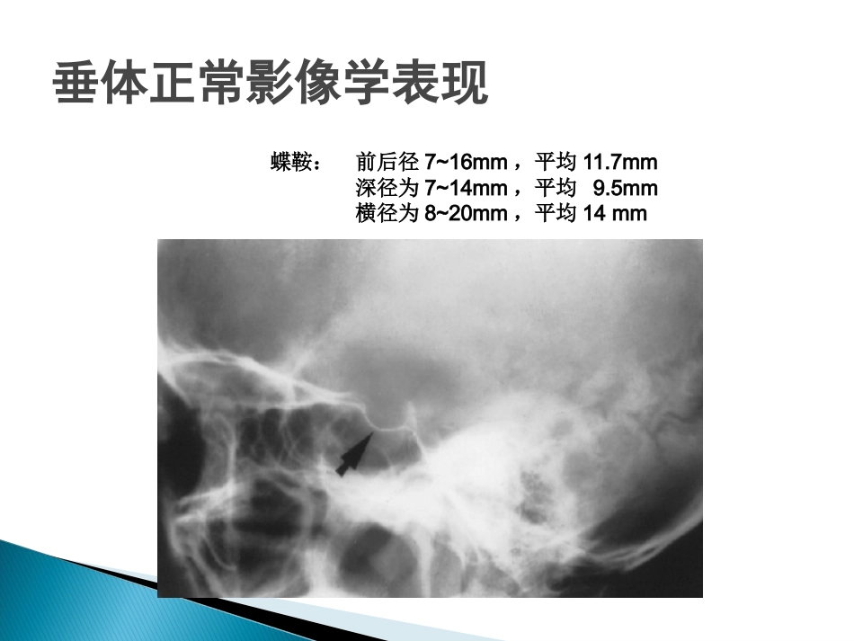 垂体疾病的影像诊断_第7页