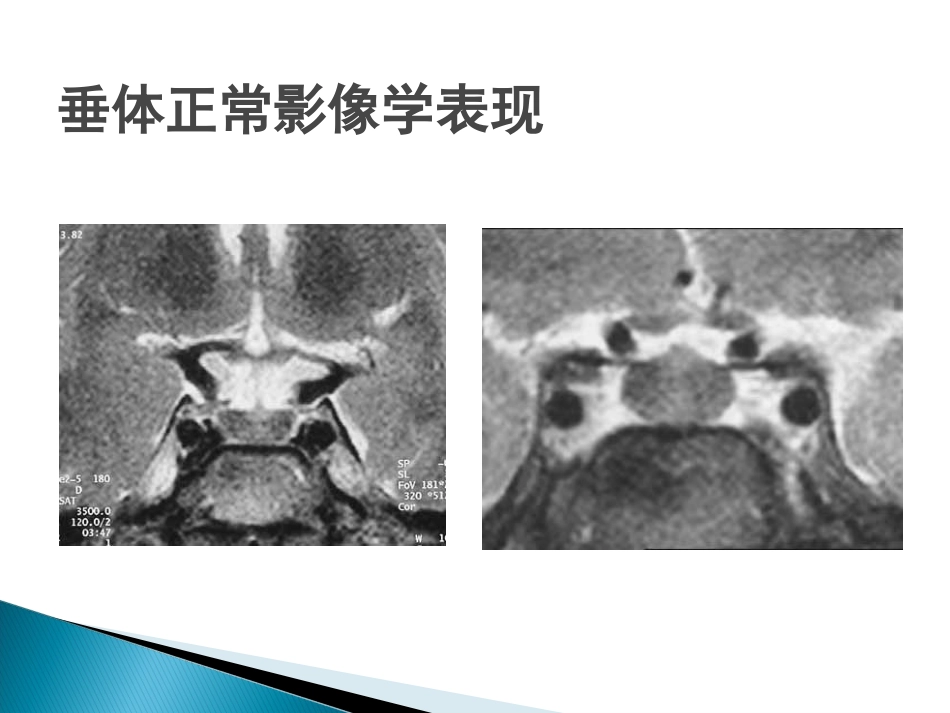 垂体疾病的影像诊断_第9页