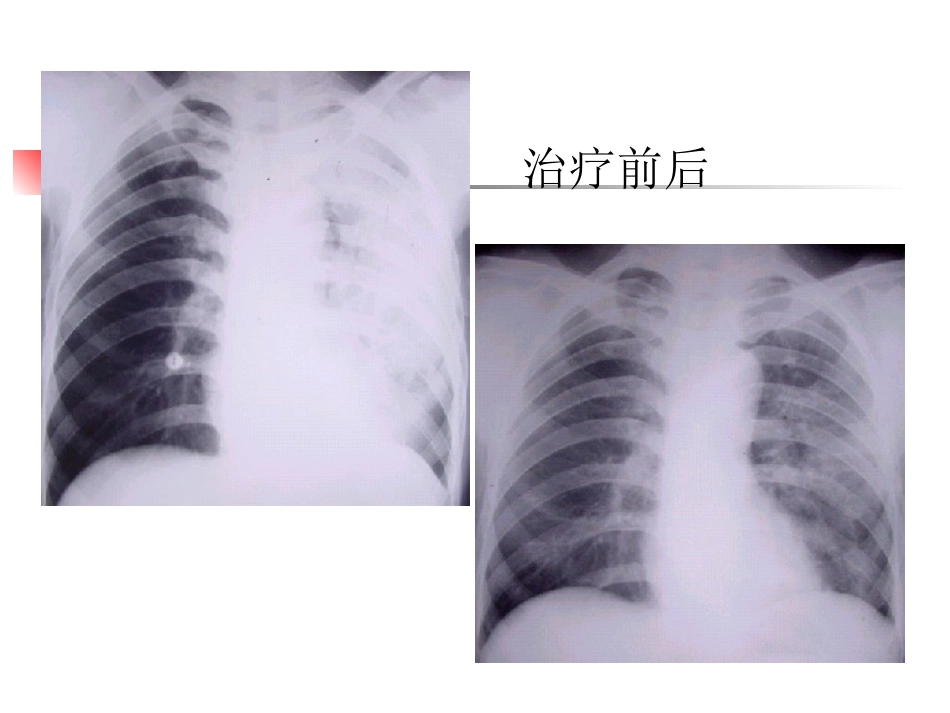大叶性肺炎的影像诊断_第10页