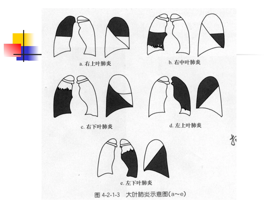 大叶性肺炎的影像诊断_第11页