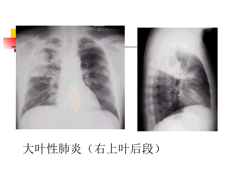大叶性肺炎的影像诊断_第6页