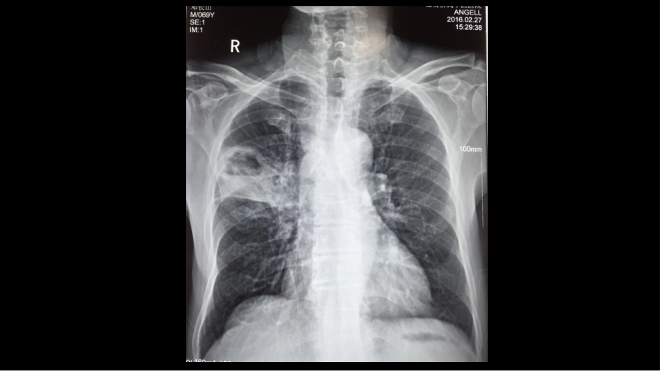 肺部空洞性病变CT与MRI_第11页