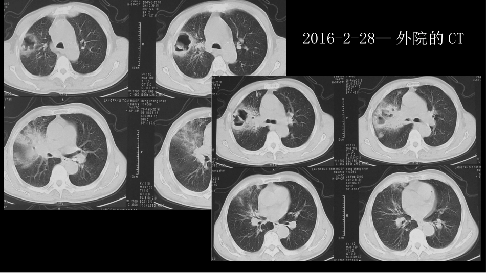 肺部空洞性病变CT与MRI_第12页