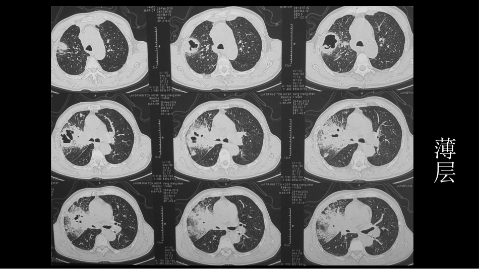 肺部空洞性病变CT与MRI_第13页