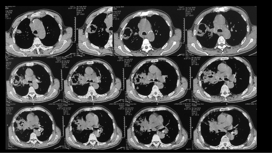肺部空洞性病变CT与MRI_第14页