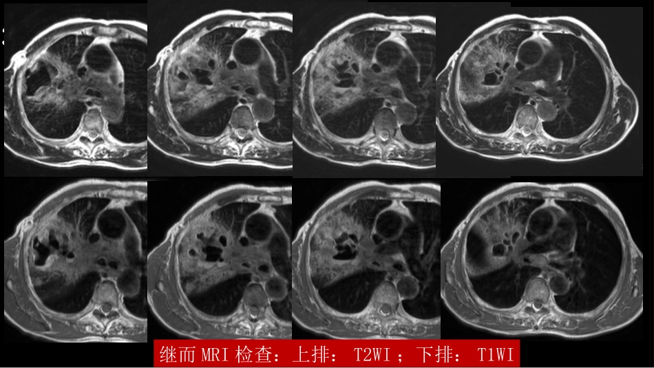 肺部空洞性病变CT与MRI_第15页