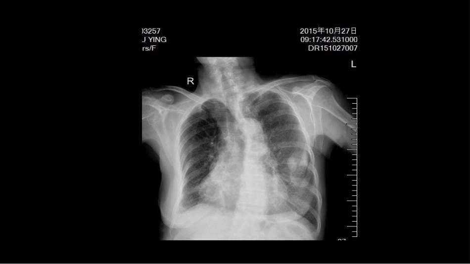 肺部空洞性病变CT与MRI_第4页