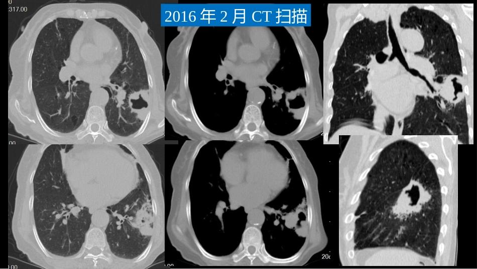 肺部空洞性病变CT与MRI_第5页