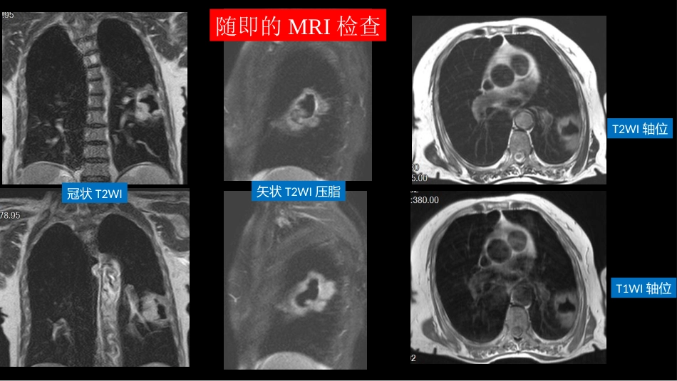 肺部空洞性病变CT与MRI_第6页