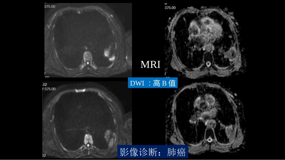 肺部空洞性病变CT与MRI_第7页