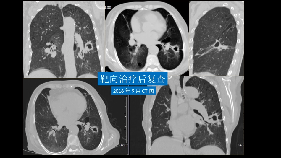 肺部空洞性病变CT与MRI_第8页