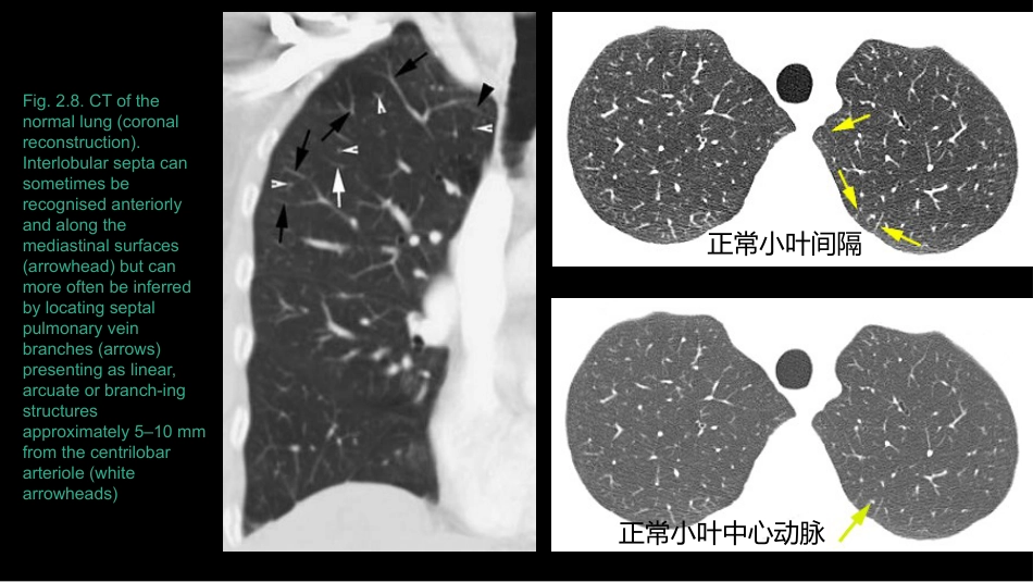 肺部影像学部分病理征象解读_第10页