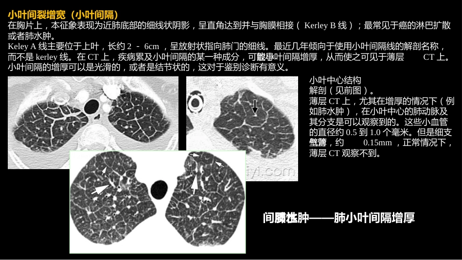 肺部影像学部分病理征象解读_第13页