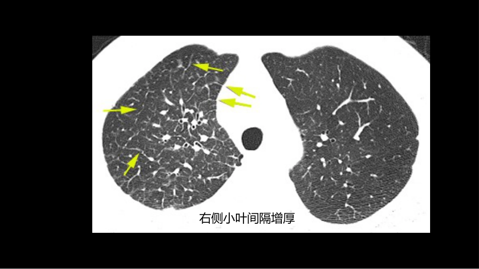 肺部影像学部分病理征象解读_第14页