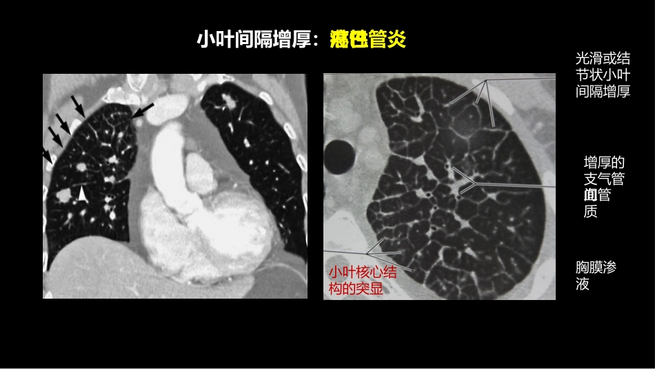 肺部影像学部分病理征象解读_第15页