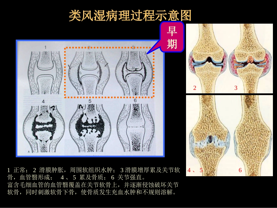 类风湿性、强直性脊柱炎的影像学诊断_第5页