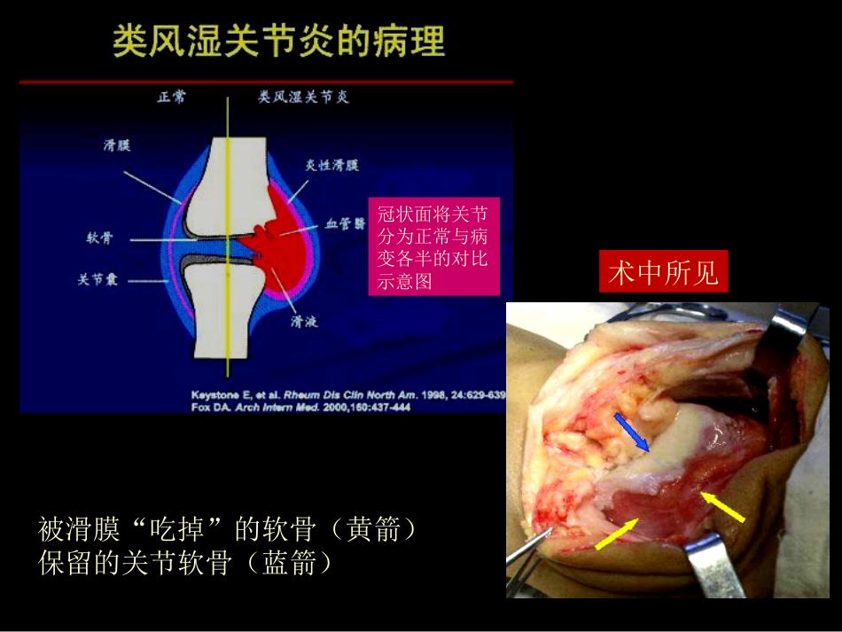 类风湿性、强直性脊柱炎的影像学诊断_第6页
