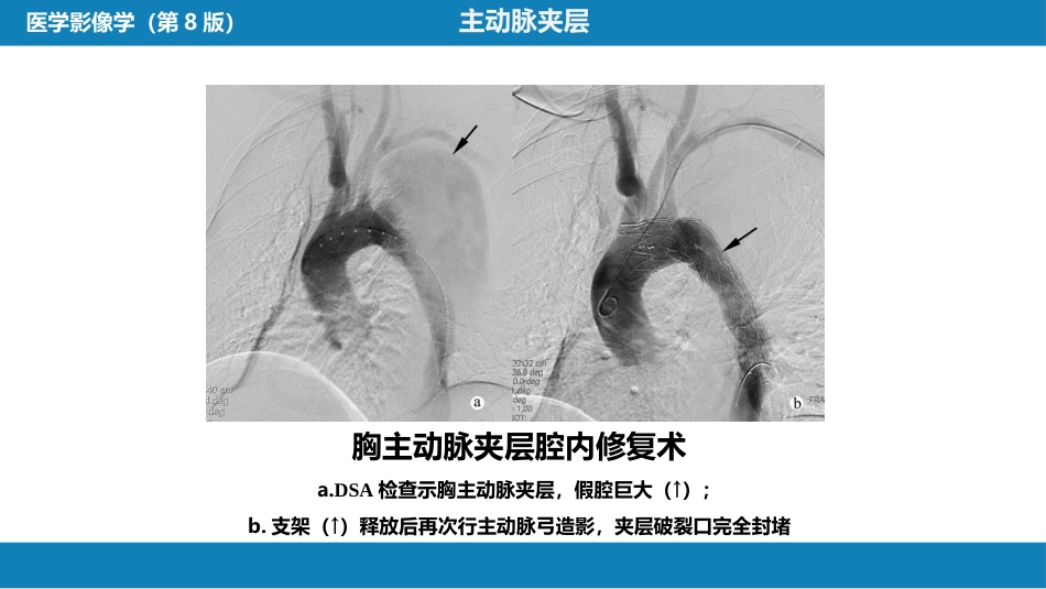 第十三章 血管疾病介入治疗_第10页