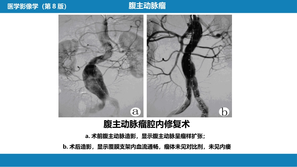 第十三章 血管疾病介入治疗_第15页