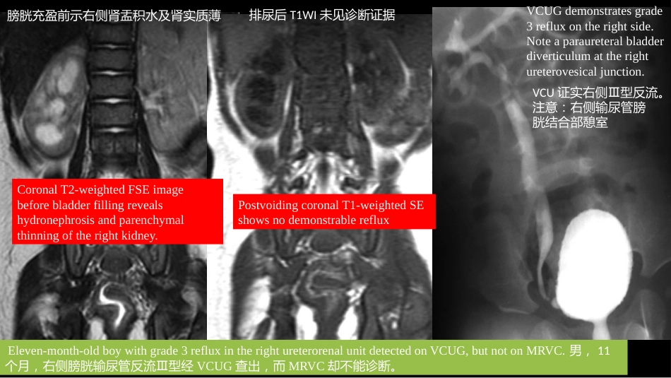 影像科容易忽略的病：膀胱输尿管反流_第10页