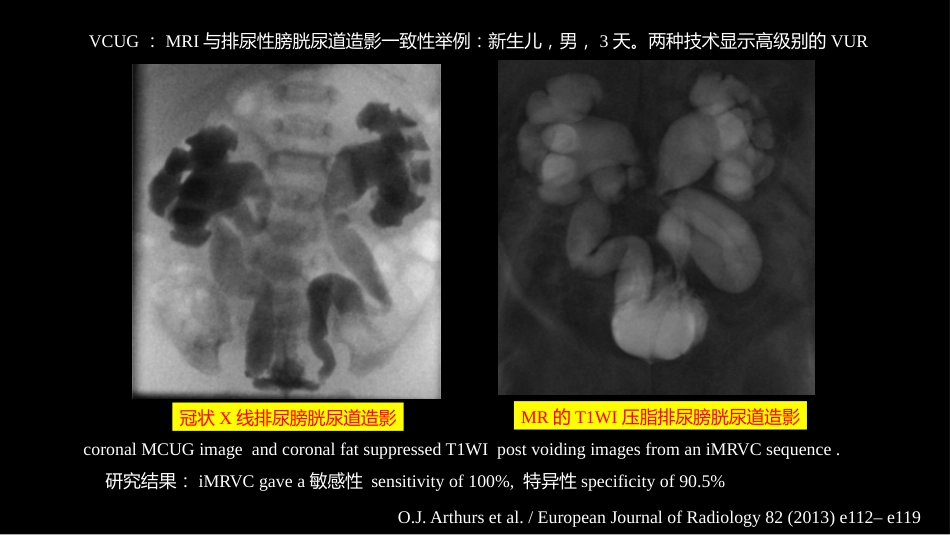 影像科容易忽略的病：膀胱输尿管反流_第11页