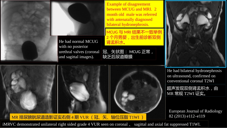 影像科容易忽略的病：膀胱输尿管反流_第12页