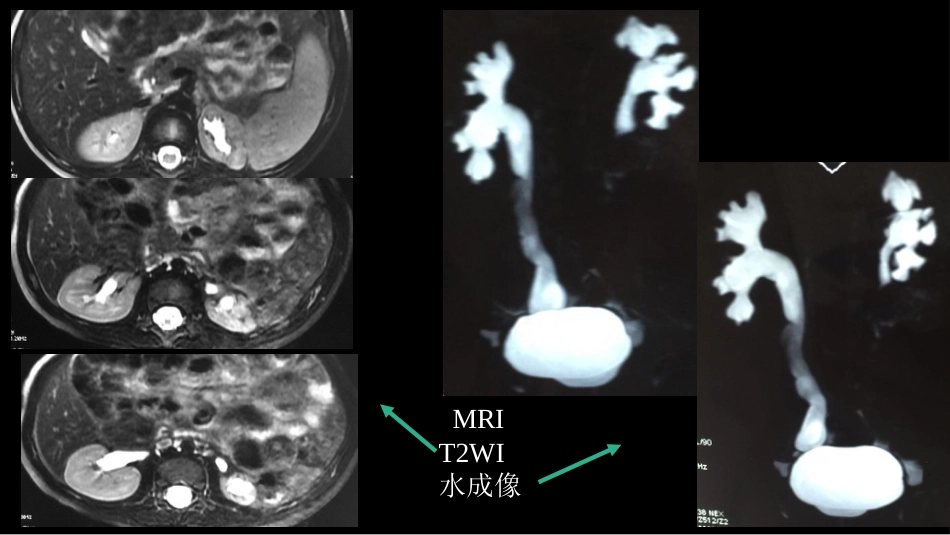 影像科容易忽略的病：膀胱输尿管反流_第3页