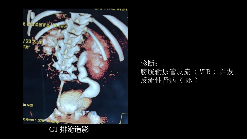 影像科容易忽略的病：膀胱输尿管反流_第4页