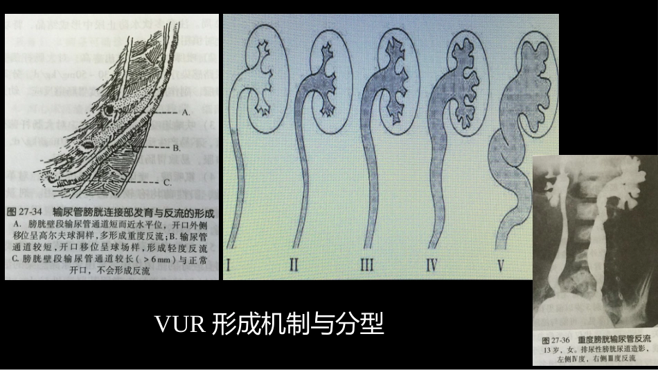 影像科容易忽略的病：膀胱输尿管反流_第7页