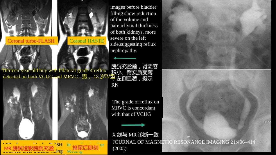 影像科容易忽略的病：膀胱输尿管反流_第9页