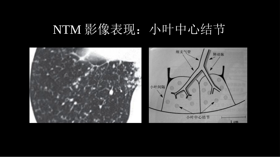 非结核分支杆菌病影像学(NTM)-修改版_第13页
