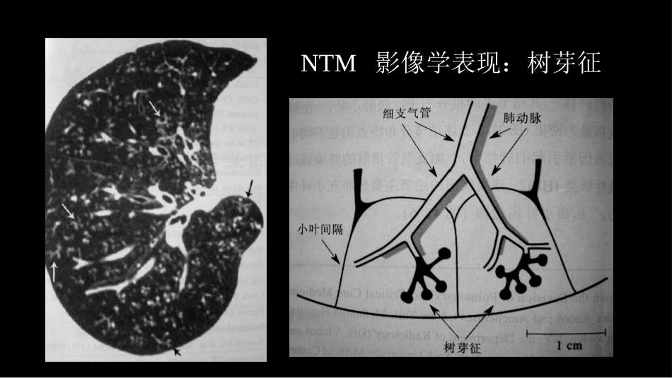 非结核分支杆菌病影像学(NTM)-修改版_第14页