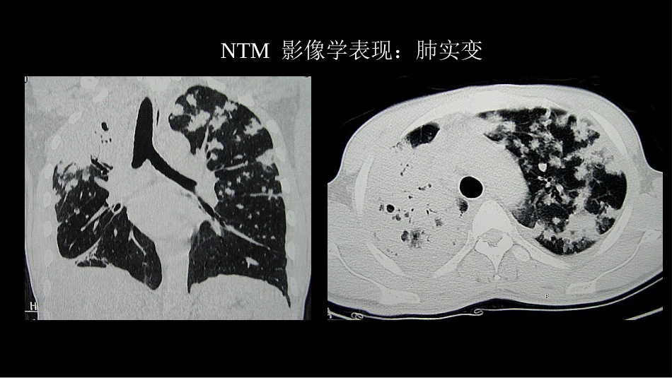 非结核分支杆菌病影像学(NTM)-修改版_第15页